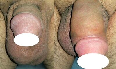Акс пеш аз ва пас аз баланд бардоштани penis